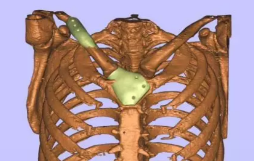 一迈智能助力首例3D打印PEEK锁骨置换